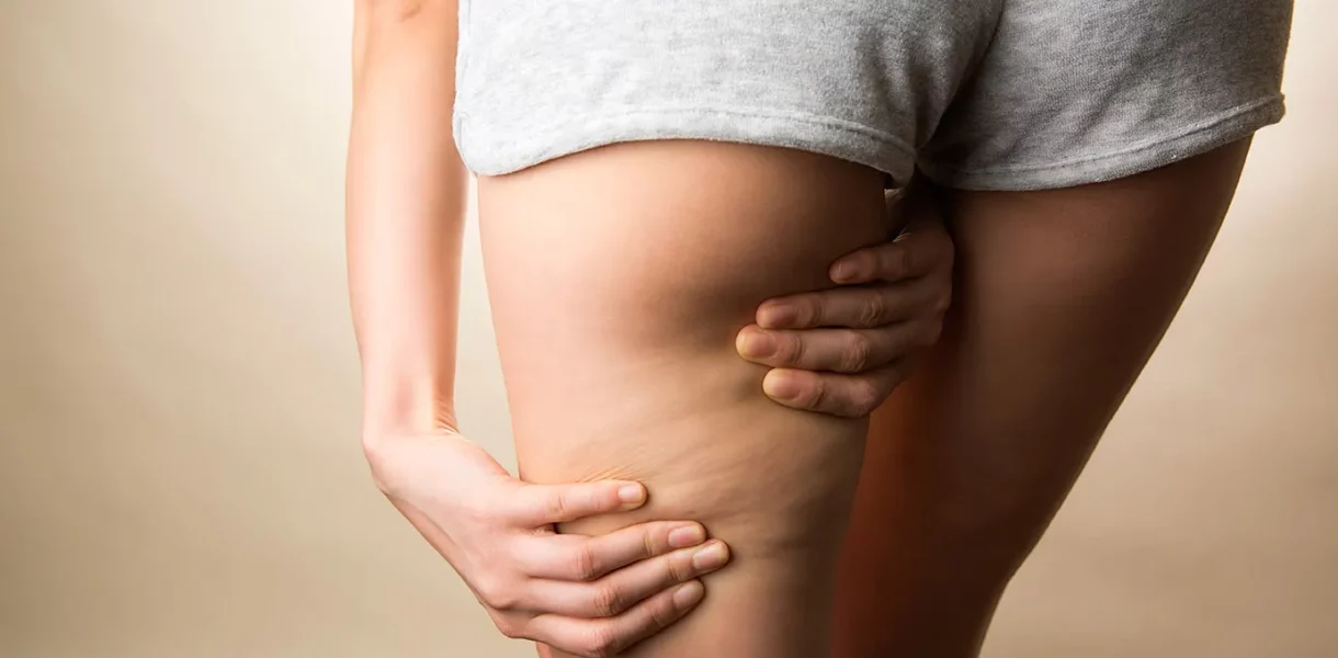 Cellulite et madérothérapie