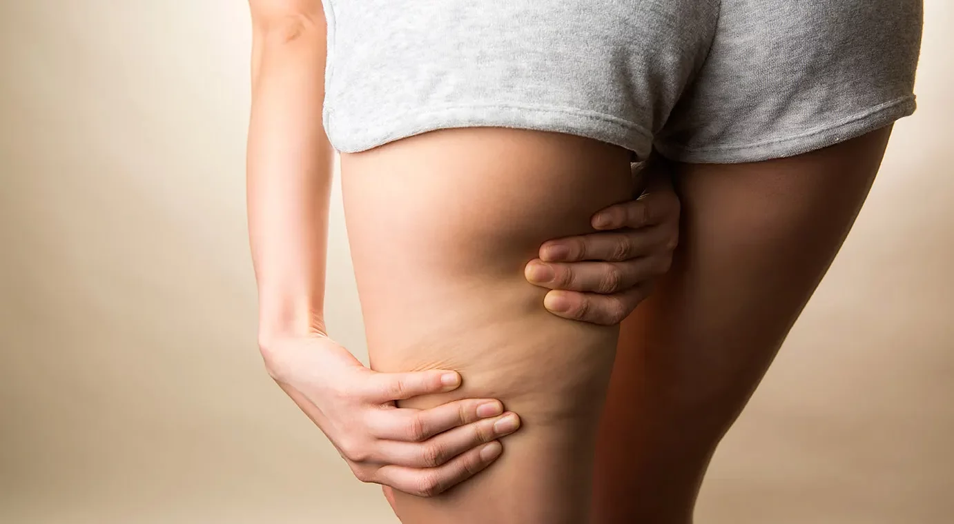 Cellulite et madérothérapie