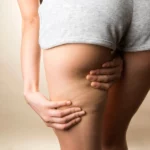 Cellulite et madérothérapie
