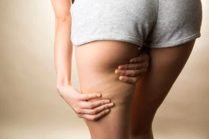 Cellulite et madérothérapie