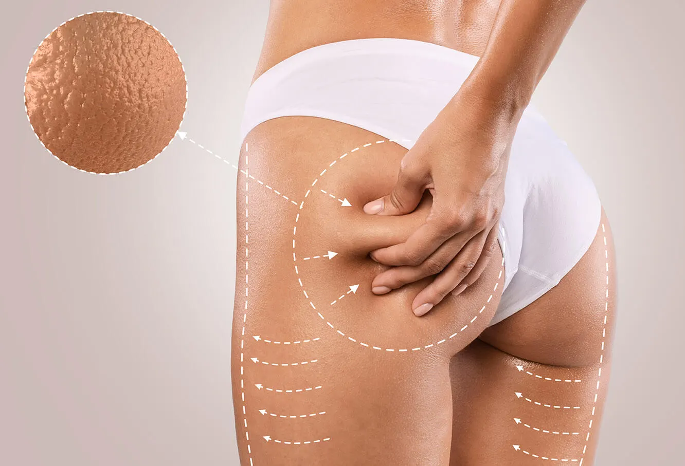 Cellulite et madérothérapie